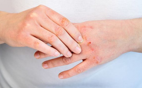 乳膠手套能否有效防止長(zhǎng)水泡？